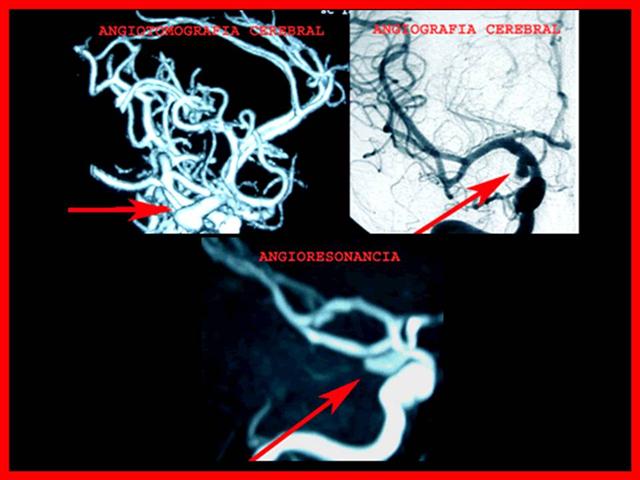 Angio IRM angiografia angiotac