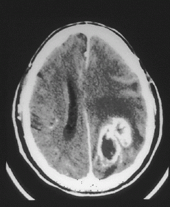 tumor cerebral