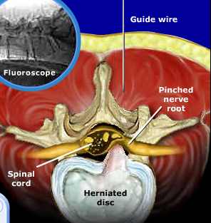 Se localiza el nivel exacto de la hernia por fluoroscopí­a (rayos X)
