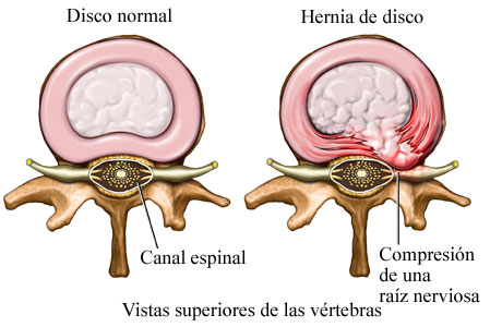 hernia de disco lumbar